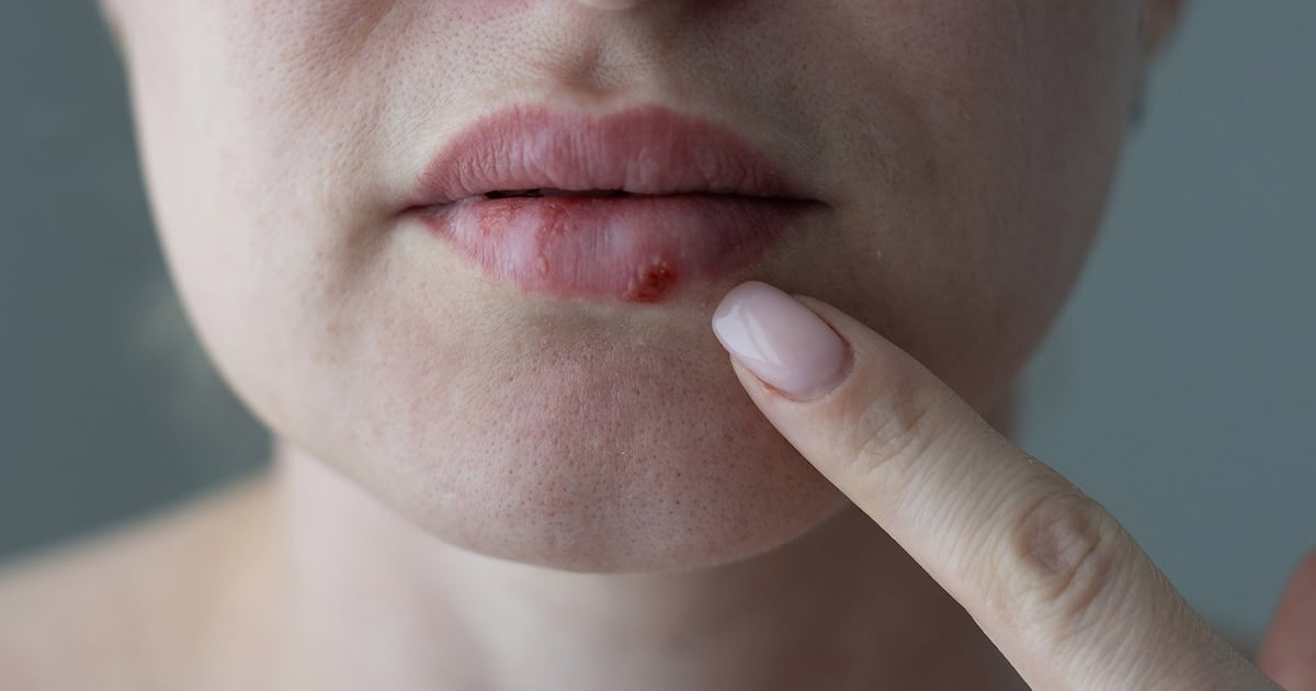 Un paso que se esperaba: la FDA aprueba un antiviral oral contra el herpes resistente y abre una puerta en pacientes sin defensas