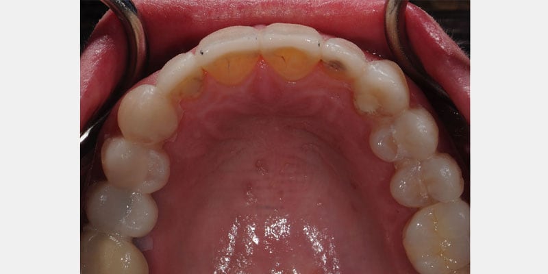 Carillas dentales: cuando el sellado se rompe, el diente queda expuesto